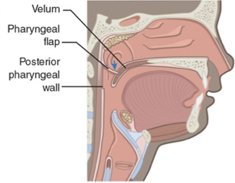 <p>What VPI surgery is this?</p>
