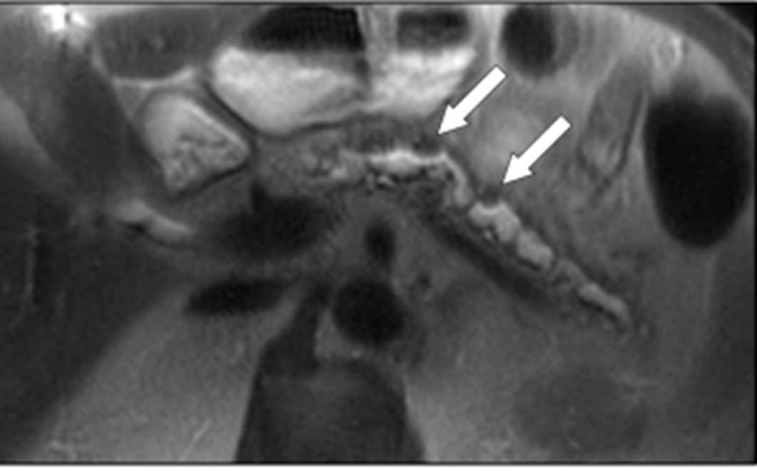 <p>irreg dilated ducts and side branches</p>