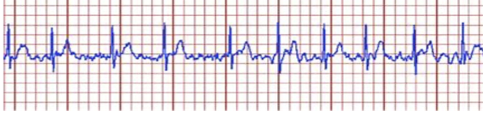 <p>a physical therapist is ambulating a patient and they report palpitations, SOB and fatigue. What should be the interpretation and immediate action according on the ECG strip shown below? </p><p>a. ventricular fibrillation, call for a defibrillator</p><p>b. premature ventricular contractions; take them to their bed and monitor for changes in ECG </p><p>c. atrial fibrillation; stop exercise and report the physician </p><p>d. 3rd degree heart block; activate emergency </p>