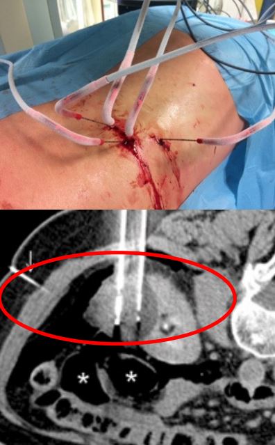 <p>62 let, Ž, hematurija, hipernefrom </p><p></p><ol><li><p>Imenuj metodo zdravljenja </p></li><li><p>Način vodenja posega? </p></li><li><p>Kateri organ je prikazan? (rdeči krog) </p></li><li><p>Kurativno?paliativno?zdravljenje</p></li></ol><p></p>
