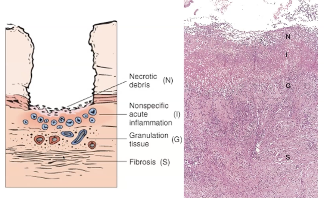 <ul><li><p>Necrosis-fibrinoid debris.</p></li><li><p>Inflammation - neutrophils.</p></li><li><p>Granulation tissue - macrophages, endothelial cells, fibroblasts.</p></li><li><p>Scar - fibrous collagenous scar.</p></li></ul><p></p><p>A peptic ulcer shows a sharply demarcated mucosal defect with a <strong>characteristic four‑layered histological appearance</strong>. The surface contains <strong>necrotic, eosinophilic debris</strong>, underlain by a band of <strong>acute inflammatory cells</strong>, mainly neutrophils. Beneath this lies <strong>granulation tissue</strong> composed of proliferating capillaries, fibroblasts, and chronic inflammatory cells. The deepest layer is a <strong>dense fibrous scar</strong>, which may distort the underlying muscularis propria. Surrounding mucosa often shows chronic gastritis. This layered pattern reflects ongoing injury from acid and pepsin alongside attempts at healing.</p>