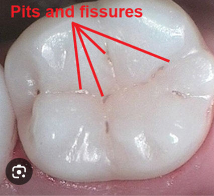 <p>small pinpoint depressions located at junction of developmental grooves or terminals of those grooves</p>