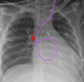 <ul><li><p>Monitors heart function and blood flow. Cardiac output and CVP</p></li><li><p>Positioned in R or L main pulmonary artery, with the tip not extending beyond the medial lung field</p></li></ul><p></p>