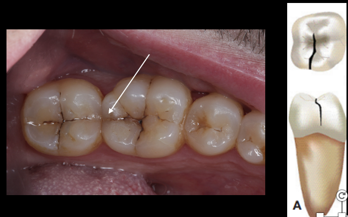 <p>a thin surface disruption of enamel and dentin, and possibly cementum , of unknown depth or extension</p>