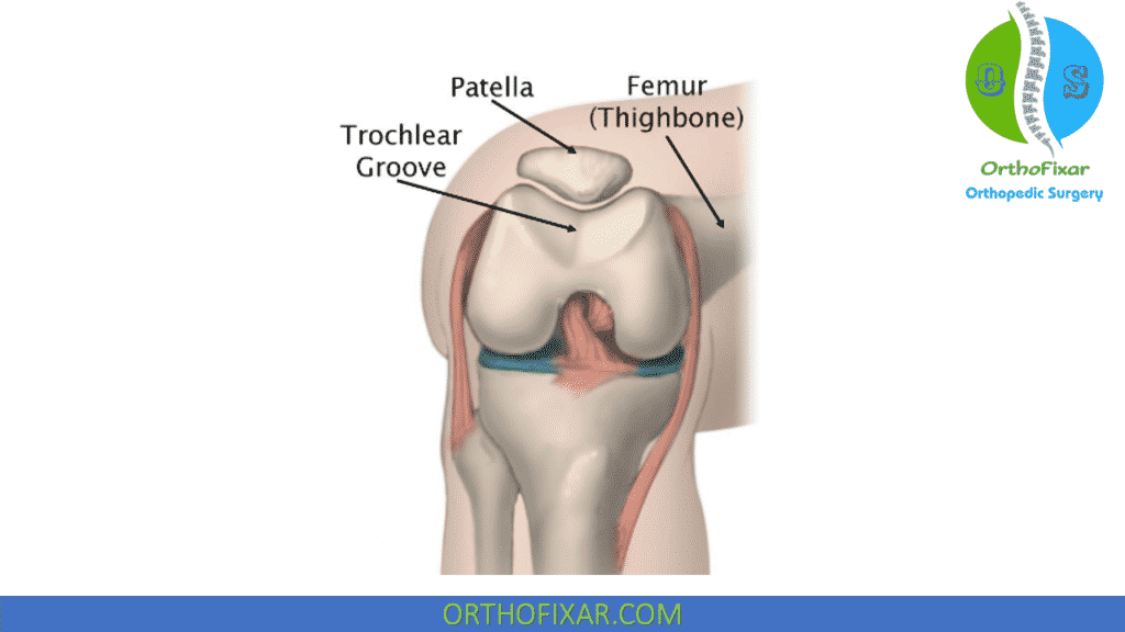 <p>Patellofemoral tracking surface; replaced by the anterior flange of the femoral component.</p>