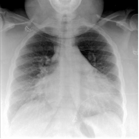<p>What does the image demonstrate about pulmonary edema?</p>