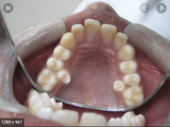 <p>-supernumerary molar, usually small and rudimentary</p><p>-situated buccally or lingually to one of the maxilary molars or in the interproximal space buccal to 2nd and 3rd molar</p>