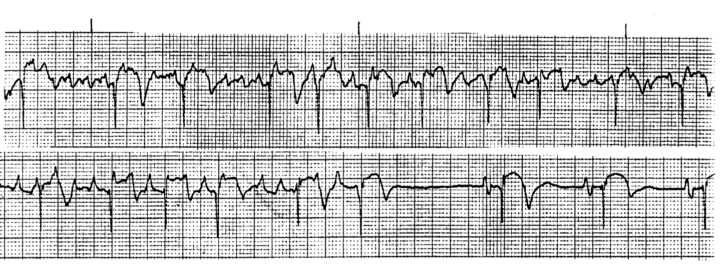 <p>What ECG is this? </p>
