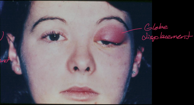 <ul><li><p>Fever</p></li><li><p>Feels ill</p></li><li><p>Proptosis/globe displacement</p></li></ul><p></p>