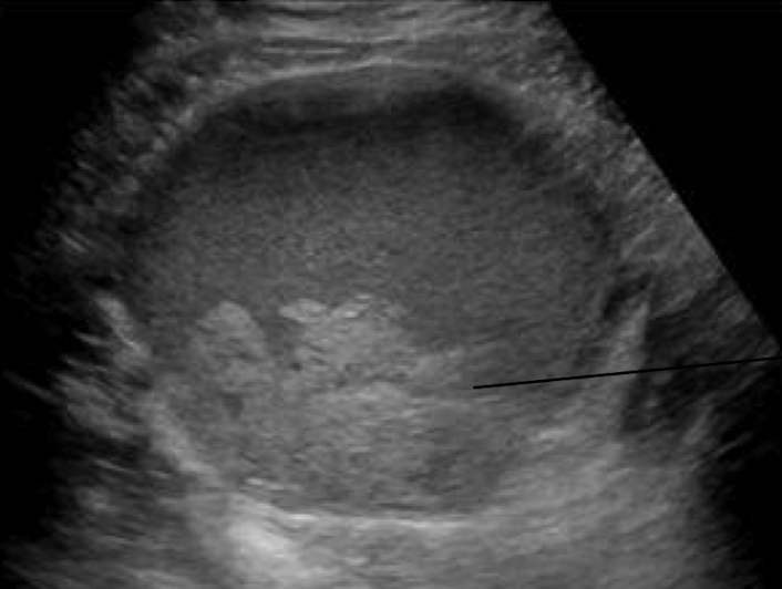 <ul><li><p>well-defined unilocular or multilocular </p></li><li><p>predominantly cystic mass</p></li><li><p>diffuse homogenous, low-level internal echoes </p></li></ul><p></p>