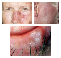<p>What is the most likely diagnosis ?</p>