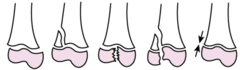 <p>What are the salter harris classifications?</p>