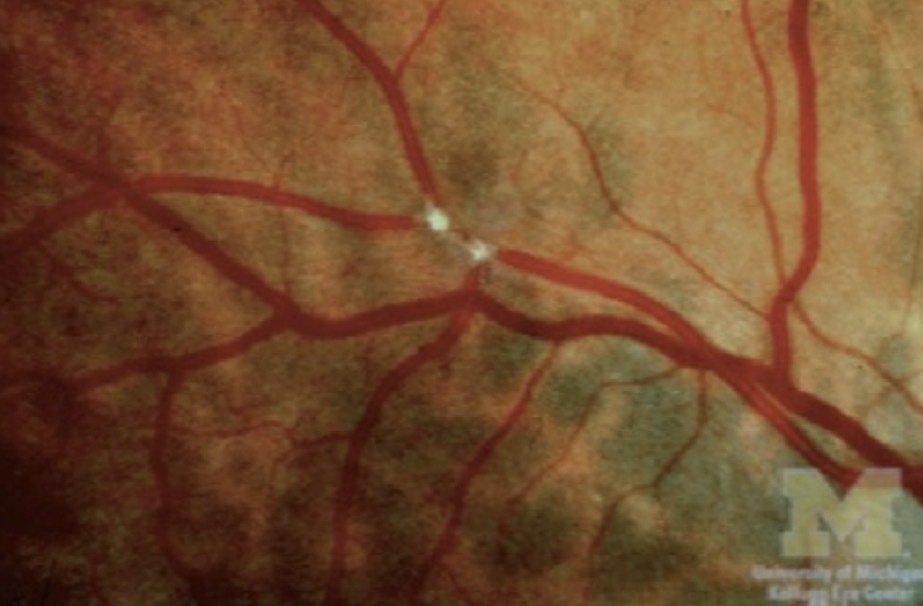 <p>Dans quelle entité peut-on retrouver cette anomalie?</p><p></p><p>A. Occlusion de l'artère centrale de la rétine</p><p>B. Neurofibromatose de Von Recklinghausen</p><p>C. ﻿﻿﻿Occlusion de branche veineuse de la rétine</p><p>D. ﻿﻿﻿Toutes ces réponses sont bonnes</p>