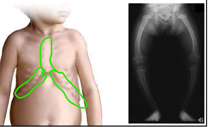 <ul><li><p>plačios epifizinės linijos - rachitiniai karoliai</p></li><li><p>subperiostinės medž. perteklius kaktikaulyje ir maleoluose (kulnkšneliusoe) -deformuoti kaulai</p></li><li><p>pakaušio kaulo lankstumas</p></li><li><p>kojų iškrypimas X, O</p></li><li><p>kaulinės sijos netvarkingos</p></li></ul><p></p>