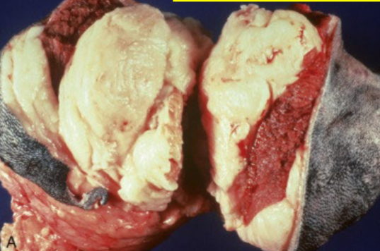 <p>What is the likely cause of this lesion?</p>
