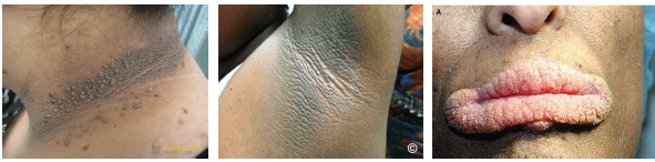 <p>•Screen patients for diabetes and insulin resistance</p><p>•Evaluate for possible underlying malignancy</p><p>•Review medications contributing to condition</p><p>•Treat underlying cause to reduce lesions</p><p>•Lesions may resolve with systemic control</p>