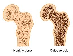 <ul><li><p>decrease in bone mass when bone resorption exceeds formation</p></li><li><p>common with aging</p></li><li><p>women lost bone mass more quickly than men starting at 50</p><ul><li><p>50 is also start of menopause (ovaries reduce production of estrogen = less osteoblastic activity for production of bone matrix)</p></li></ul></li></ul><p></p>