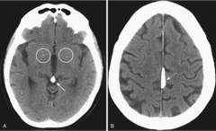 <p>- bone or blood = white (arrows = blood) </p><p>- air, water, CSF = dark</p><p>- metal causes streak artifact</p>