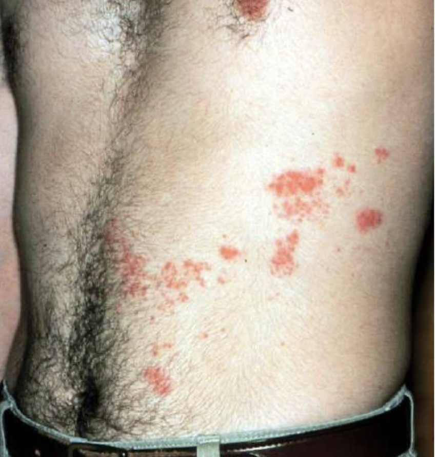 <p>what are these lesions associated with and what is it called</p>