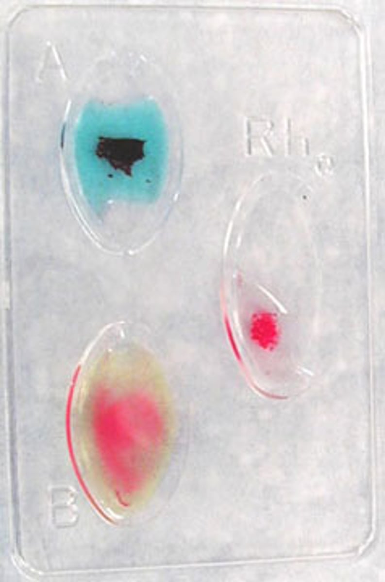 <p>What type of blood is this?</p>
