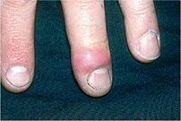 <p>Name this + its etiology</p>