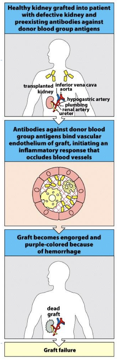 <p>pre- existing Ab in recipient.</p><p> Immune complexes form on vessels → inflammation → complement → rejection/organ loss</p><p> Prevented by HLA and ABO matching and Cross Match Test</p>