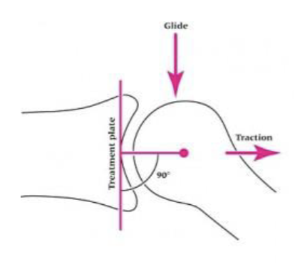 <p><span>Treatment plane </span></p><ul><li><p><span>is<strong> parallel</strong> to the <strong>deepest part</strong> of <strong>concavity</strong></span></p></li><li><p><span>is <strong>perpendicular</strong> to the<strong> line running from the axis of rotation</strong> in the <strong>convex</strong> joint partner</span></p></li></ul><p></p>