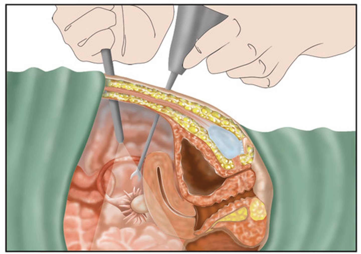<p>laparoscopic surgery</p>