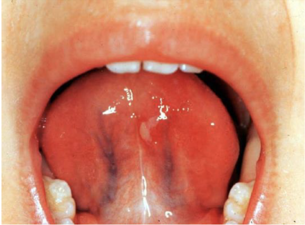 <p>what is this lesion and what is it associated with</p>