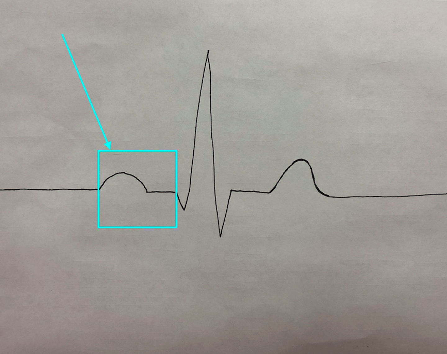 <p>time it takes to travel from SV node to ventricle muscle tissue; time measured in seconds</p>