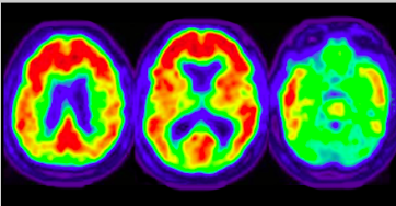 <ul><li><p>position emission topography</p></li><li><p>detects radioactive form of glucose while the brain performs a task (red = hot spots)</p></li></ul><p></p>