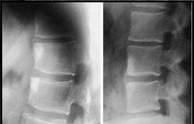 <p>What two findings of AS are found in this image</p>