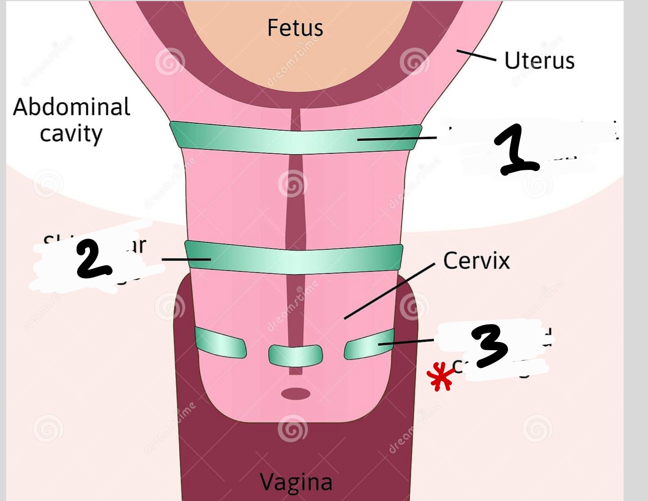 <p>What are the three types of cerclage</p>
