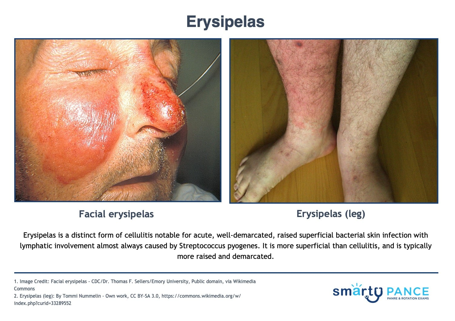 <p>Cellulitis with sharply demarcated, raised borders and lymphatic involvement. Almost always due to Group A Strep </p><p>-Presentation: looks like cellulitis but is well-demarcated and superficial. Redness, pain, fever, and chills</p><p>-Dx: clinical </p><p>-Tx: penicillin </p>