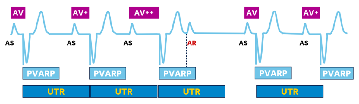 <p>The UTR is the maximum rate at which the device will pace the ventricles in response to atrial tracking.</p><p>Therefore, atrial rates above the UTR will exhibit a phenomenon of lengthening AS-VP intervals, until eventually atrial events fall into PVARP</p>