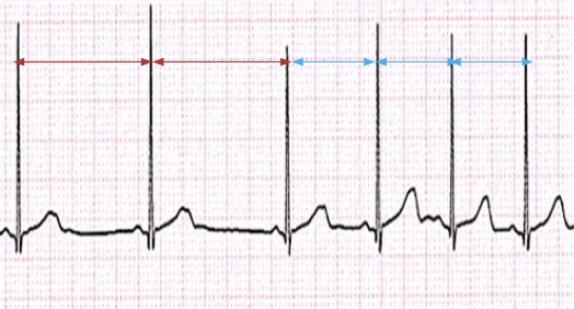 <p>heart rate increases with inspiration & decreased with exhalation (R-R intervals are not consistent)</p>