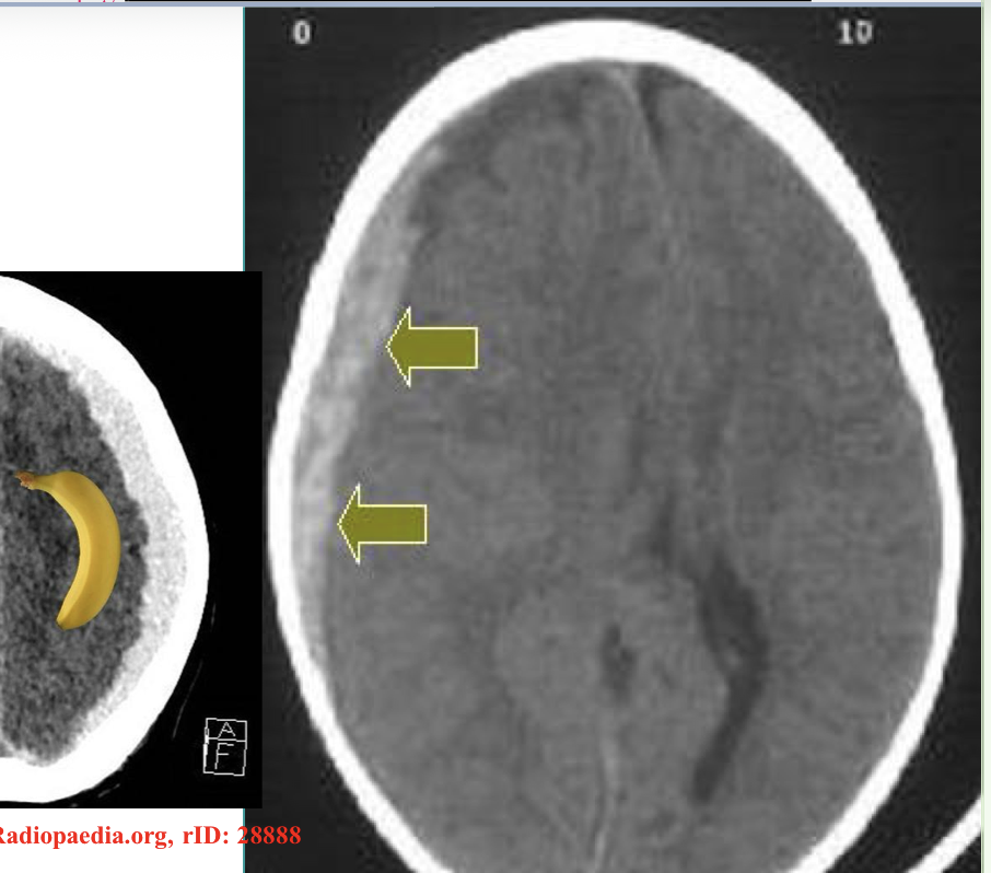 <p>What type of hematoma is found on this x-ray</p>