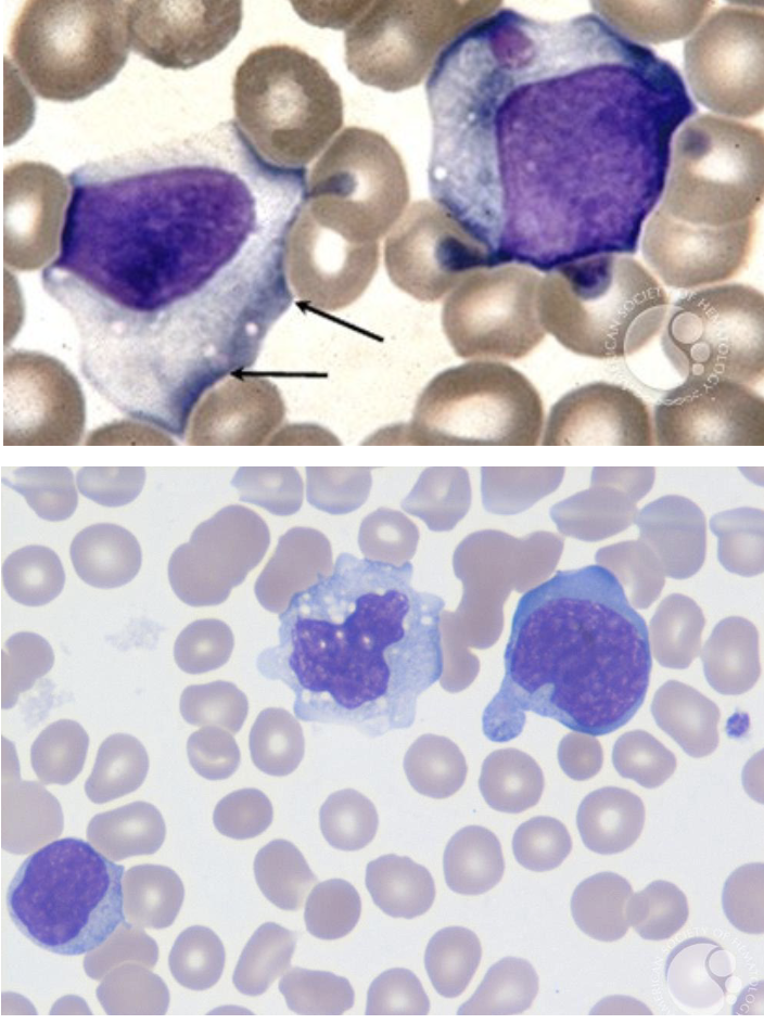 <p>kissing disease caused by EBV</p><p>symptoms include enlarged spleen</p><p>lymphocytes have scalloped margins, indentations by surrounding RBCs, vacuolated cytoplasm</p><p>“ballerina skirt”</p>