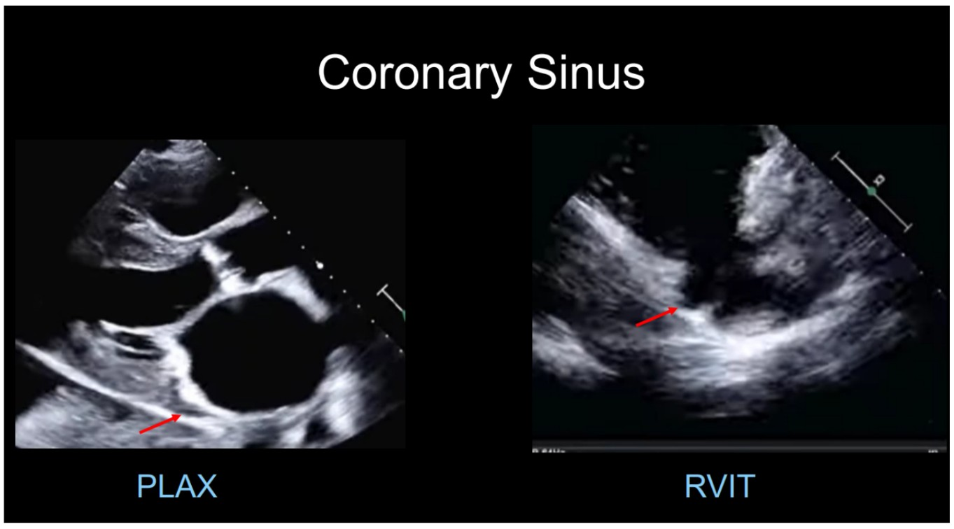 <p>- lies within a sulcus called the AV sulcus or AV groove (epicardium) and empties into RA </p><p>- drains the coronary veins into the RA </p><p>- Thebesian valve sits at the opening</p>