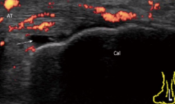 <p><span style="background-color: transparent;">Tendon-related pain and symptoms associated with inflammation → increased vascularity&nbsp;</span></p>