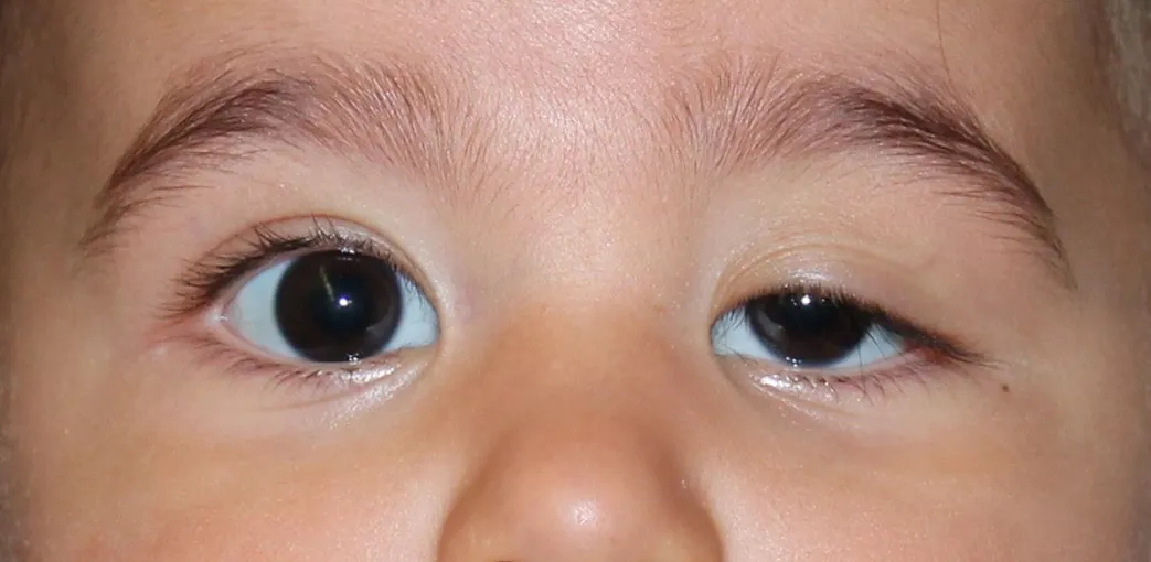 <ul><li><p><span style="background-color: transparent; font-family: "EB Garamond", serif;">Drooping of upper eyelid</span></p></li><li><p><span style="background-color: transparent; font-family: "EB Garamond", serif;">Nerve dysfunction or muscle weakness</span></p></li></ul><p></p>