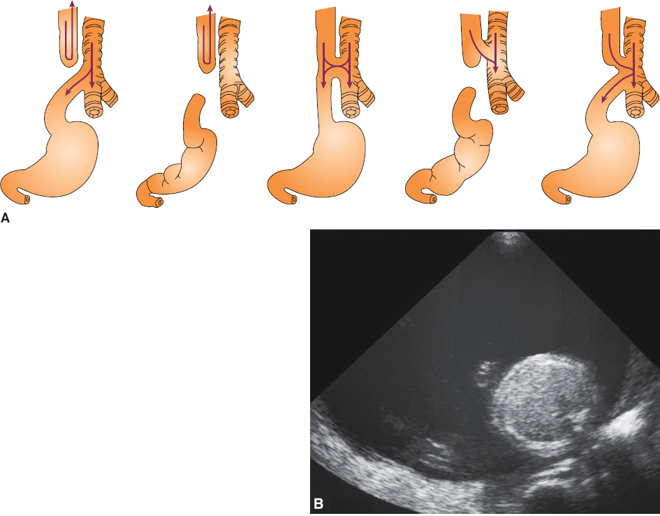 <p>tracheoesophageal fistula (90% of the time)</p>