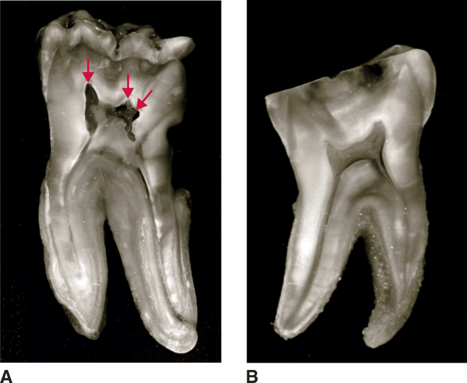 <p>Horn-like coronal extensions of the pulp chamber projecting into the cusp tips of the tooth. </p>