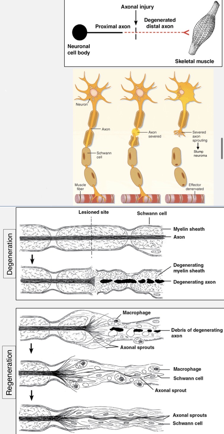 <p>when an axon is completely severed, we refer to the portion with the cell body as the proximal segment and the isolated portion as the distal segment</p><p>proximal segment undergoes some degeneration, then it may:</p><ul><li><p>regenerate (1-5 mm/day) to original or different synapse site</p></li><li><p>lead to neuronal death</p></li><li><p>become the site of neuroma formation</p></li></ul><p>distal segment undergoes Wallerian degeneration (total degeneration) because protein synthesis occurs at the soma</p><ul><li><p>myelin requires contact by axon to remain intact, so it too degenerates</p></li><li><p>schwann cells may remain intact or degenerate over time</p></li></ul><p>damaged neurons can regenerate back to their original site if the cell body survives and the regenerating axon can make contact with distal schwann cells (which secrete chemotropic factors)</p><p>factors that decrease likelihood of functional nerve regrowth:</p><ul><li><p>damage near the soma</p></li><li><p>severe and/or crushing injury</p></li><li><p>misalignment of segments</p></li><li><p>scar tissue formation</p></li><li><p>old age of patient</p></li></ul><p></p>
