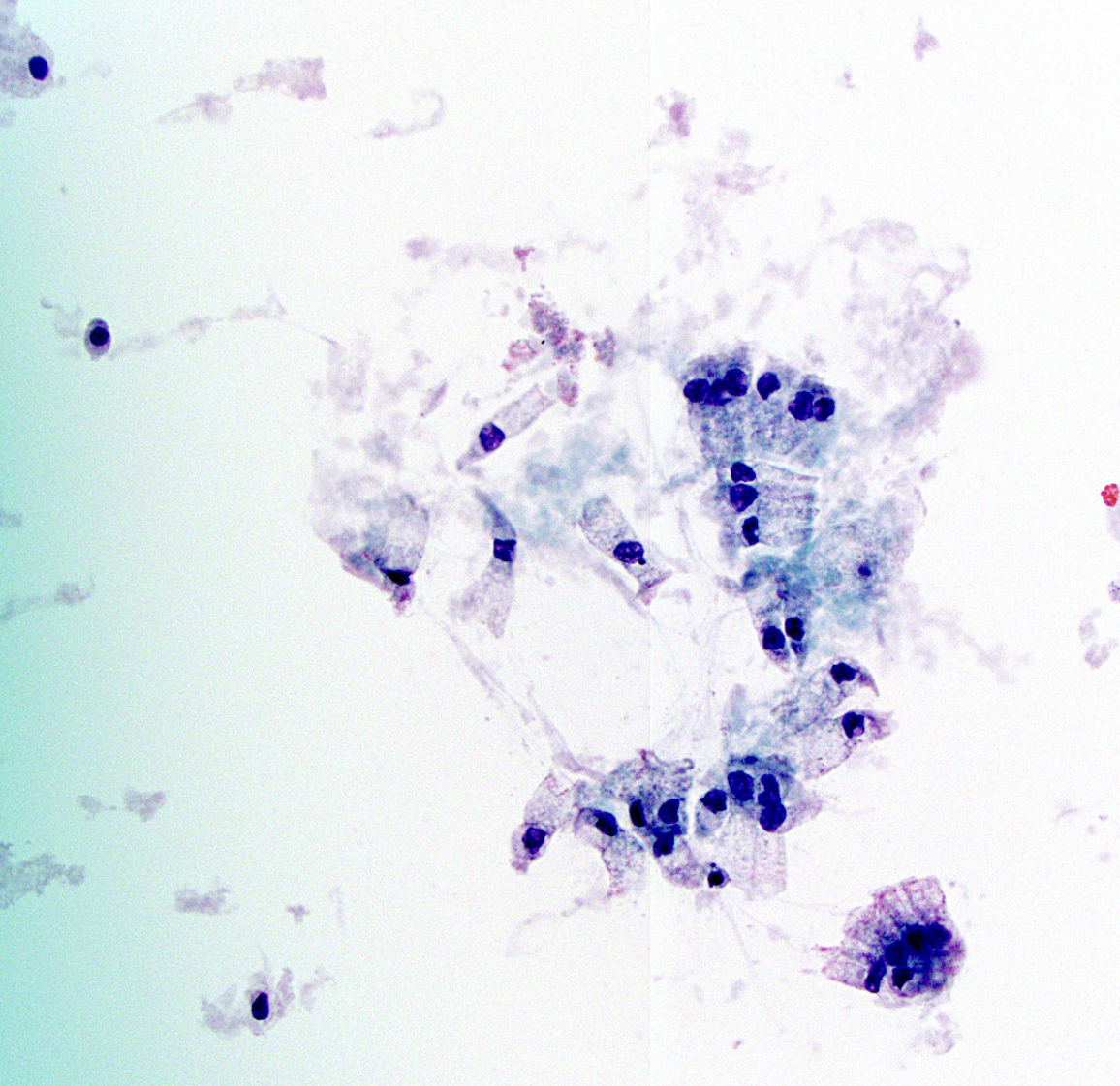 <p>Kyste du pancreas</p><p>1) diagnostic</p><p>2) morphologie</p><p>3) biochimie</p><p>4) altérations moléculaire</p><p>5) altérations moléculaire de haut risque</p><p>6) risque de malignité</p>