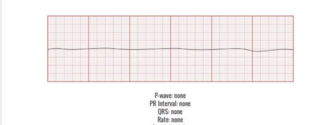 <p>Causes</p><p><span><span>Follows VT/VF in cardiac arrest</span></span></p><p><span><span>-Acidosis</span></span></p><p><span><span>-Hypoxia</span></span></p><p><span><span>-Hypokalemia</span></span></p><p><span><span>-Hypothermia</span></span></p><p><span><span>-Overdose</span></span></p><p></p><p><span><span>Interventions</span></span></p><p><span><span>Cpr</span></span></p><p><span><span>Epinephrine </span></span></p>