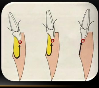 <p>-three teeth have entirely different ones</p><p>-shape variations of EoFs is due to the different incisal edge positions of the uppers</p><p>-different incisal edge positions therefore also produce different AGs</p>