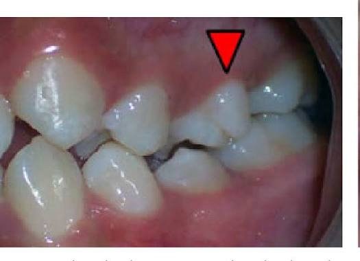 <p>smaller elevation on some portion of <u>crown</u> produced by extra formation of enamel</p>