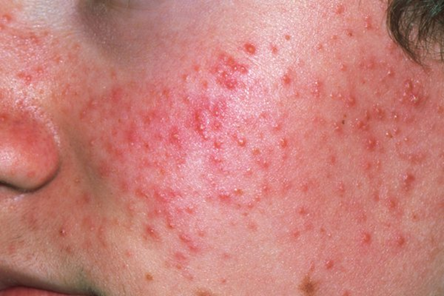 <p>Causative Agent: Cutibacterium acnes</p><p>Symptoms/Signs: Inflamed, swollen spots on the face, chest, or back.<br></p>