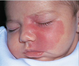 <p>sturge-weber syndrome (SWS)</p>